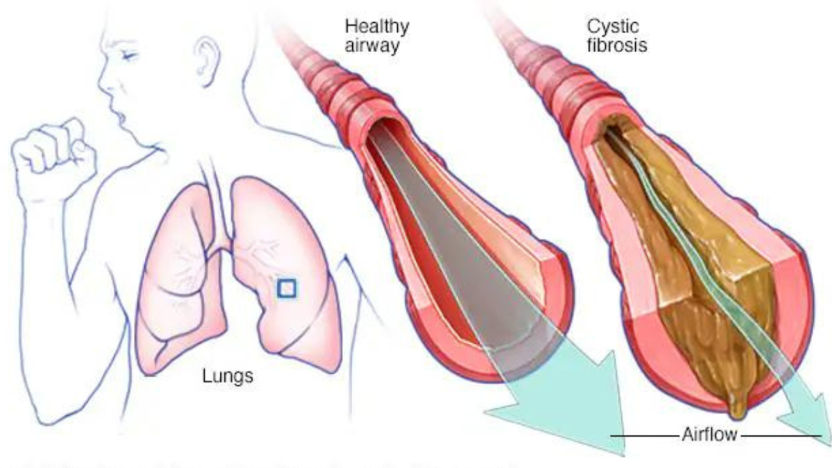 Foto: Especial | Debido a un gen defectuoso que afecta a las glándulas productoras de moco, la fibrosis quística afecta a miles de personas.